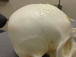 Point 2 labels the Coronal suture, which is seen on the lateral side of the skull. Beneath it is Point 3 which is the Sphenoid Bone, also seen in the lateral view of the skull. Point 2 labels the Coronal suture, which is seen on the lateral side of the skull. Beneath it is Point 3 which is the Sphenoid Bone, also seen in the lateral view of the skull.